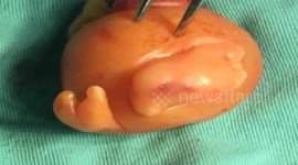 Baby has embryo removed from its body 15 days after birth