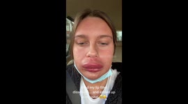 'I got my lip fillers dissolved and ended up in hospital,' says woman, 23, going viral after being compared to DONALD DUCK