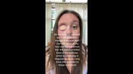One-eyed Sheffield mum has leg skin graft covering empty socket – producing own HAIR and BLOOD SUPPLY Part 1