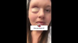 One-eyed Sheffield mum has leg skin graft covering empty socket – producing own HAIR and BLOOD SUPPLY Part 3