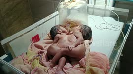 Indian mother hopes for successful surgery for pair of twins joined at chest