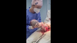 Incredible moment twin baby born inside amniotic sac