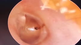 Doctor removes poisonous ant from inside of girl's ear