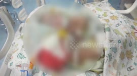 Conjoined twins successfully separated in 2-hour operation in eastern China