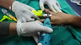 Rescuers remove nut rings from woman's hand after her fingers swell