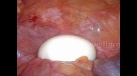 Doctors remove