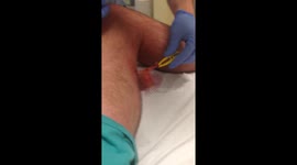 Man films gruesome spider bite injury on his leg in Australia