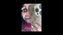 Woman shares horrific video of her face after cosmetic surgery complications. Part 3
