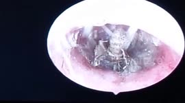 Live butterfly is removed from patient's ear canal in Vietnam
