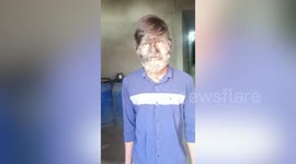 Boy suffers rare 'werewolf syndrome', has long facial hair in central India