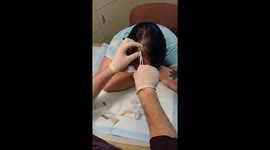 I had a cyst extracted from my head