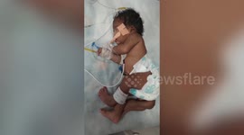 Woman gives birth to four-legged baby girl in India