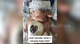 Baby born with half a heart and given