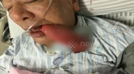Doctors remove giant tongue-like growth from man's mouth
