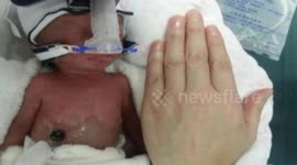 Premature baby with hand-sized body appears in China, weighing 550g