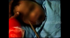 Chopstick gets stuck in baby's eye socket