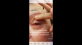 Mum-of-six forced to have eye REMOVED after infection sees it DETACH from socket – shares warning signs to others