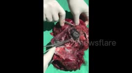 “coal” in human lung