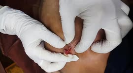 Moment dermatologist removes 2-year-old acne from patient's face