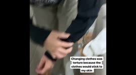 ‘Eczema cream gave me oozing ELEPHANT SKIN and left me housebound – even giving up dream career’. Part 4