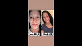 ‘Eczema cream gave me oozing ELEPHANT SKIN and left me housebound – even giving up dream career’. Part 5