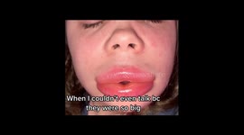 Woman thought lips would 'explode' after suffering severe allergic reaction to fillers