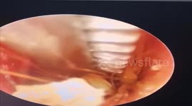 Brain garden: Vietnamese doctor removes 4 plants growing in 10-year-old boy's EAR