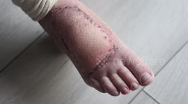 A woman was left fighting for her life when a DOLPHIN nearly bit her foot off during a wild swim