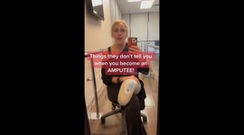 ‘I lost my leg to FLESH-EATING BACTERIA after falling over while playing with my kids,’ says mum-of-five Part 1/4