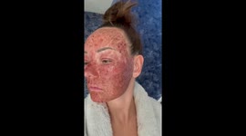 'I paid £3,000 for facial treatment to look younger and was left CRYING as my skin PEELED off'