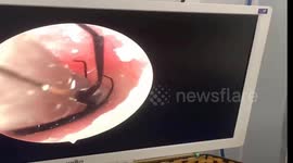 Skin-crawling clip shows doctor removing massive fly man's ear