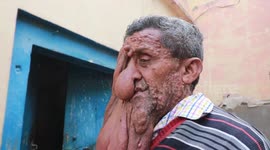 Indian man suffering from facial tumour wants to raise money so he can take care of daughter