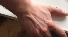Man can move vein as if there is a bug under his skin