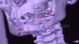 Girl has surgery to remove metal from her face after nail gun accident in China