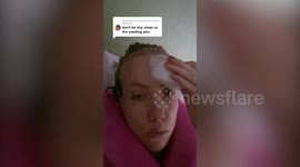 Woman who had hair transplant to cover