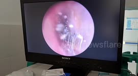 Spider found in woman's ear canal at hospital in China