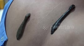 Customers try bizarre leech therapy 'to relieve body pain'