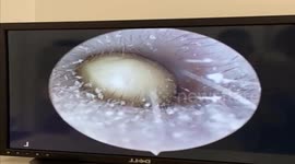 The doctor removes a pea stuck for 3 days in a 4-year-old boy's ear