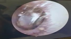 Large battery removed from 8-year-old boy's ear by doctors in Vietnam