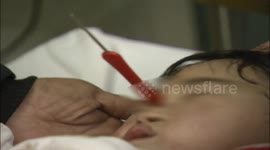 余干:两岁多女童 眼睛插进一根针