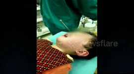 Huge nail removed from three-year-old boy's nostril in China