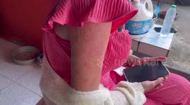Thai woman, 24, suffers horrific reaction to 'lack of sleep and bad food' leaving her covered in painful sores