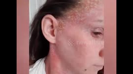 THIS MUM says steroid creams have damaged her skin so much that strangers TAKE PICTURES of her when they think she's not looking.