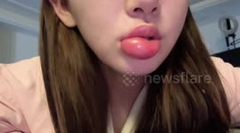 Woman's lips swell to cartoonish size after escargot meal in China