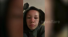 Woman could barely open her eyes after she got severe SUN POISONING
