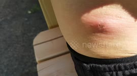Bitten by a False widow spider yesterday evening during the hot weather