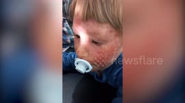 Toddler with extreme eczema seeking donations for life-changing treatment