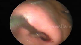 Shocking discovery: Man finds 15cm long leech living in his nose