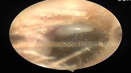 Doctor removes nesting TICK living in Vietnam man's ear for one MONTH