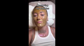 'I paid £1,400 to remove my FRECKLES – it felt like the worst sunburn of my life' PART 1/6